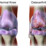 Arthritis Of The Knee