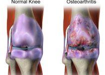 Arthritis Latest Facts: Causes, Types, Symptoms, Diagnosis, Treatment, and Complications