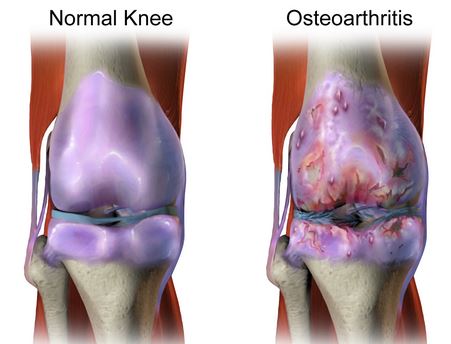 Arthritis Of The Knee