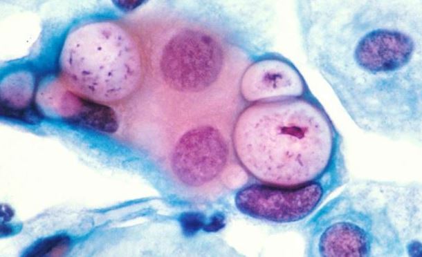 Chlamydia: Latest Facts, Symptoms, Treatments, and Complications