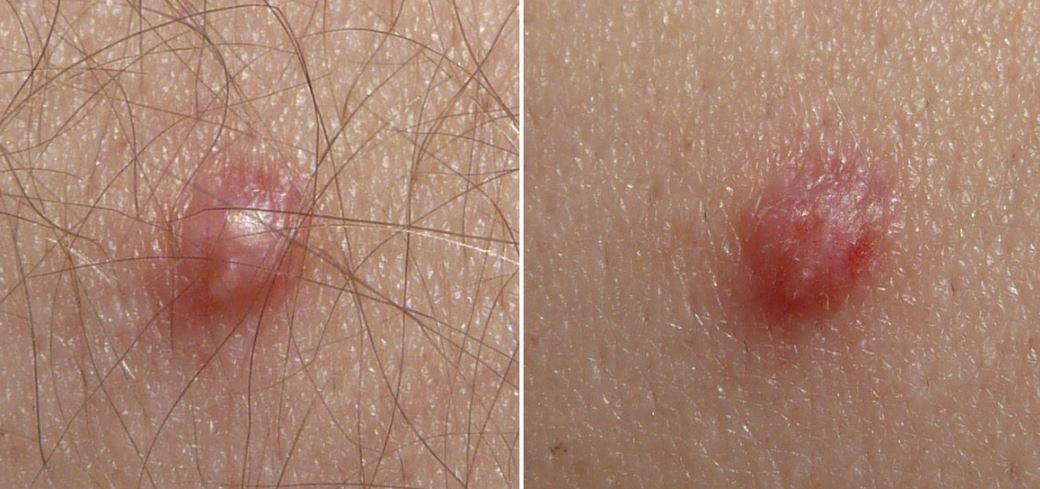 Wart or viral infection of the skin - rogather.ro - Hpv and skin lesions