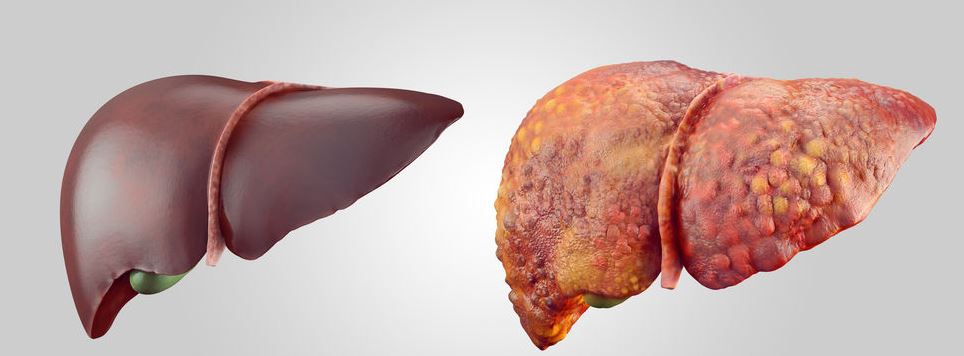 Liver Cancer Latest Facts: Causes, Risk Factors, Symptoms, Prognosis, and Treatment