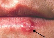 Herpes Could Finally Be Cured With CRISPR According to Study