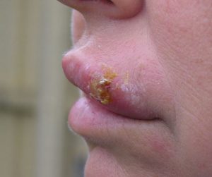 Herpes Infection On Lips