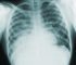 Study Reveals that Even 13 Days Post-Cold Exposure, You’re Still at Risk for Deadly Pneumonia!
