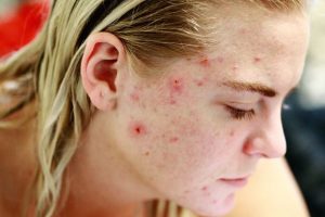 Young Woman With Acne
