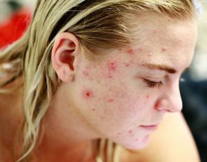 Young Woman With Acne