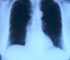 Optimizing Quality of Life in COPD Sufferers: A Resource Guide for Patients and Caregivers