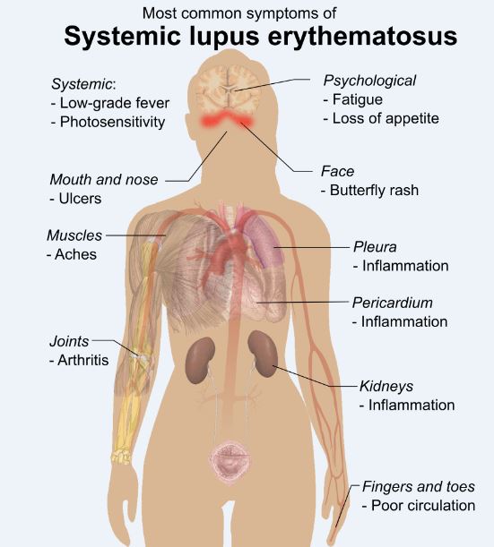 Lupus Symptoms