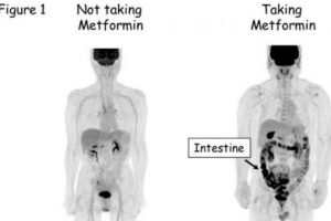 Diabetes: Metformin Transfers Blood Sugar From the Blood to the Intestines