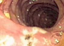 Ulcers Due To Zollinger-Ellison Syndrome