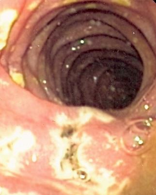 Ulcers Due To Zollinger-Ellison Syndrome
