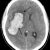 Stroke (CVA) Latest Facts: Etiology, Types, Clinical Features and Treatment