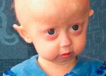 A Child With Progeria