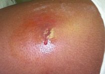 MRSA Skin Infection