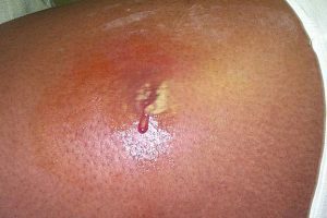 Antibiotics Must Be Prescribed Carefully for Skin Infections to Avoid a Health Crisis