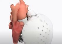 CARMAT (An Artificial Heart): A New Hope for Patients With Heart Failure CARMAT (An Artificial Heart): A New Hope for Patients With Heart Failure