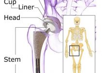 Hip prosthesis