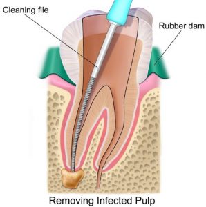 Removing Infected Pulp