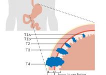 Stages of Stomach Cancer
