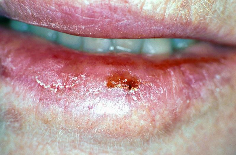 Oral Cancer Latest Facts Causes, Risk Factors, Symptoms, Prognosis