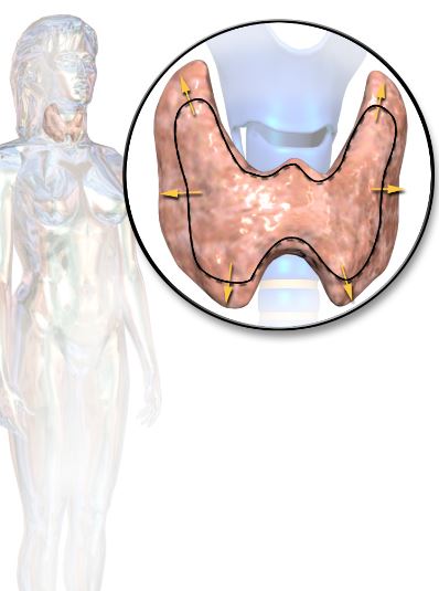 Enlarged Thyroid