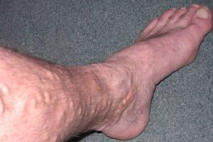 Vegetarian Men at Higher Risk for Varicose Veins: A New Study Reveals