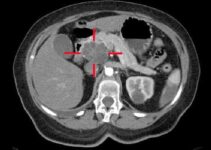 CT Image of Pancreatic Cancer