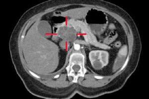 CT Image of Pancreatic Cancer