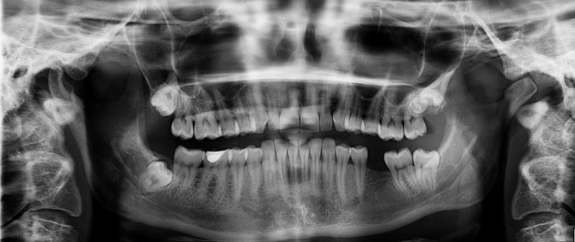 Teeth X Ray