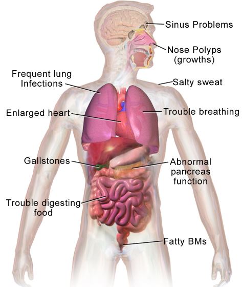 Cystic Fibrosis
