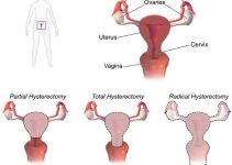 Endometriosis and Hysterectomy: Study Reveals Increased Postoperative Complications and Need for Comprehensive Surgical Planning Endometriosis and Hysterectomy: Study Reveals Increased Postoperative Complications and Need for Comprehensive Surgical Planning