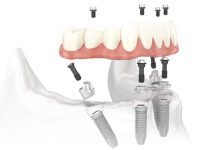 Comprehensive Guide to the All-On-4 Dental Implant Procedure: Understanding the Process, Recovery, and Long-Term Care