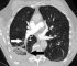 Comprehensive Guide to Pulmonary Embolism: Insights into Causes, Symptoms, Diagnosis, and Advanced Treatment Options