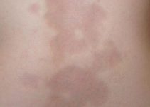 Study Shows Fresh Fat and SVF Gel Transplant as an Effective Treatment for Morphea