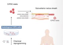 Stem Cell Transplant Achieves Insulin Independence in Type 1 Diabetes: A Case Study Stem Cell Transplant Achieves Insulin Independence in Type 1 Diabetes: A Case Study