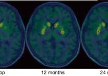 Human Trials of Stem Cell-Derived Dopamine Neurons Offer Hope for Parkinson’s Human Trials of Stem Cell-Derived Dopamine Neurons Offer Hope for Parkinson’s