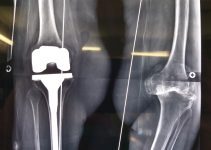 Knee Arthritis: Causes, Stages, Treatment Options, and When Surgery Becomes Necessary Knee Arthritis: Causes, Stages, Treatment Options, and When Surgery Becomes Necessary