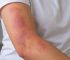 Rezpegaldesleukin Improved Moderate-to-Severe Eczema in a Phase 2b Trial, but the Bigger Test Is Still Ahead